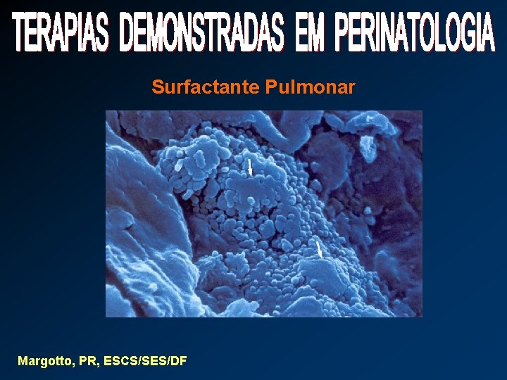 Surfactante Pulmonar Margotto, PR, ESCS/SES/DF 