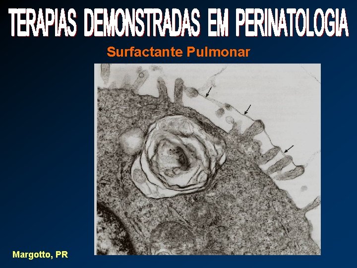 Surfactante Pulmonar Margotto, PR 