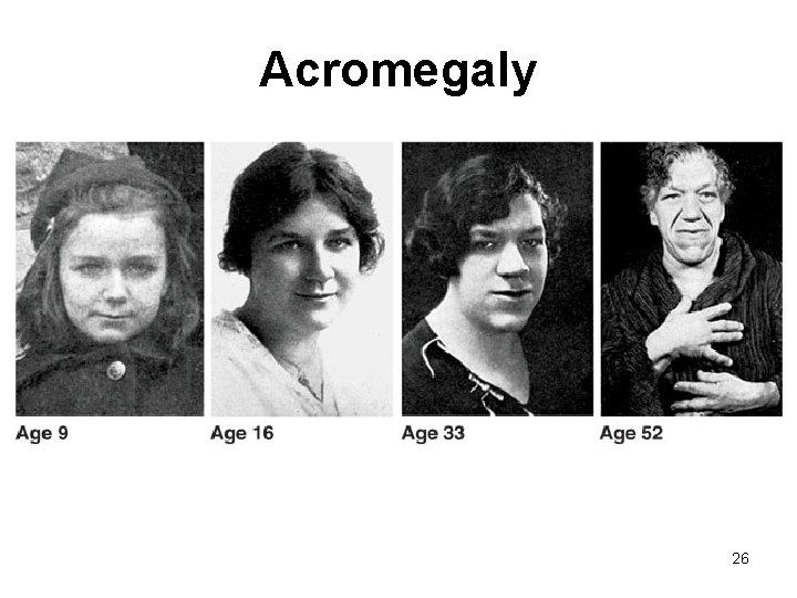 Acromegaly 26 