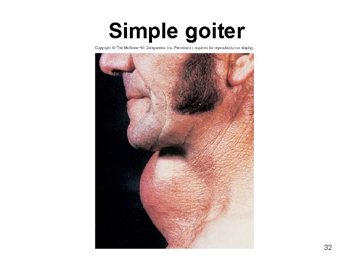 Simple goiter 32 