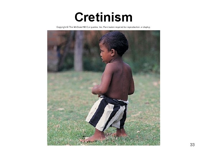 Cretinism 33 