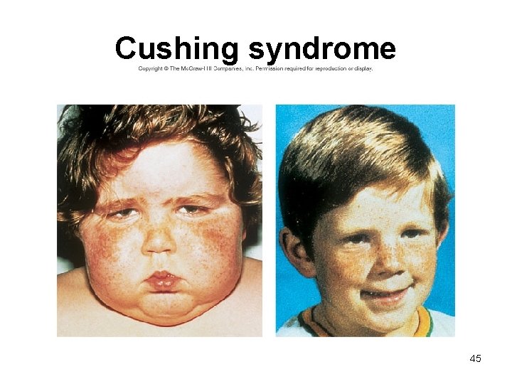 Cushing syndrome 45 