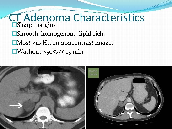 CT Adenoma Characteristics �Sharp margins �Smooth, homogenous, lipid rich �Most <10 Hu on noncontrast