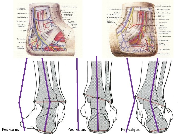 Pes varus Pes rectus Pes valgus 