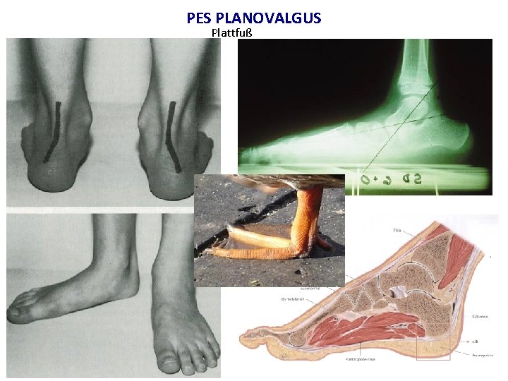 PES PLANOVALGUS Plattfuß 