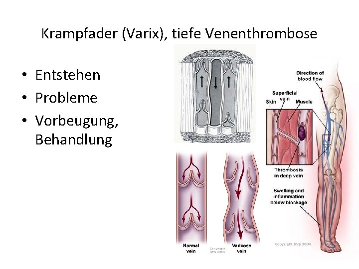 Krampfader (Varix), tiefe Venenthrombose • Entstehen • Probleme • Vorbeugung, Behandlung 