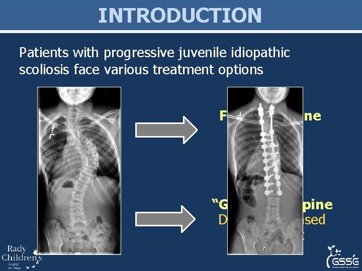 INTRODUCTION Patients with progressive juvenile idiopathic scoliosis face various treatment options Fuse the spine