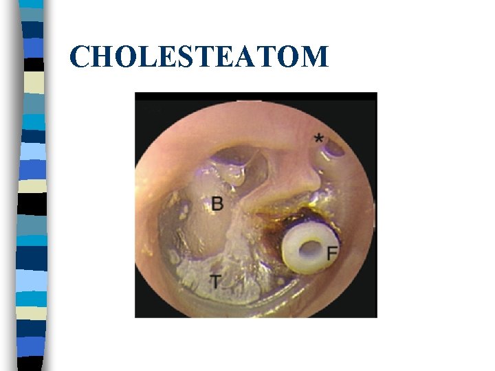 CHOLESTEATOM 