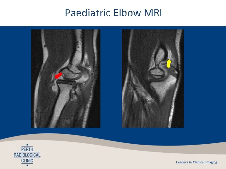 Paediatric Elbow MRI 