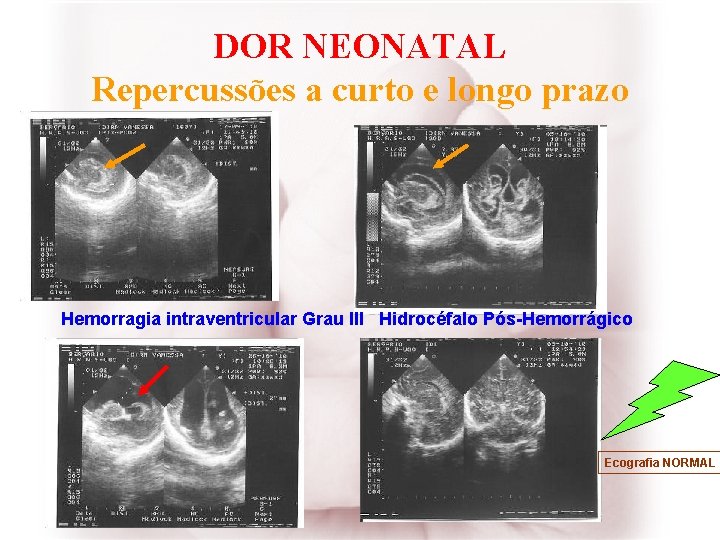 DOR NEONATAL Repercussões a curto e longo prazo Hemorragia intraventricular Grau III Hidrocéfalo Pós-Hemorrágico