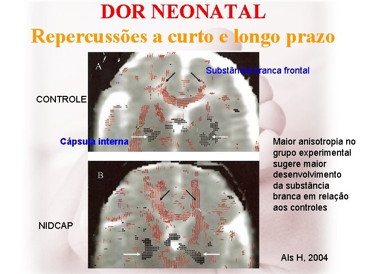 DOR NEONATAL Repercussões a curto e longo prazo Substância branca frontal CONTROLE Cápsula interna