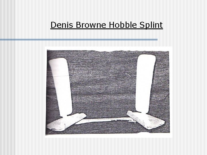 Denis Browne Hobble Splint 