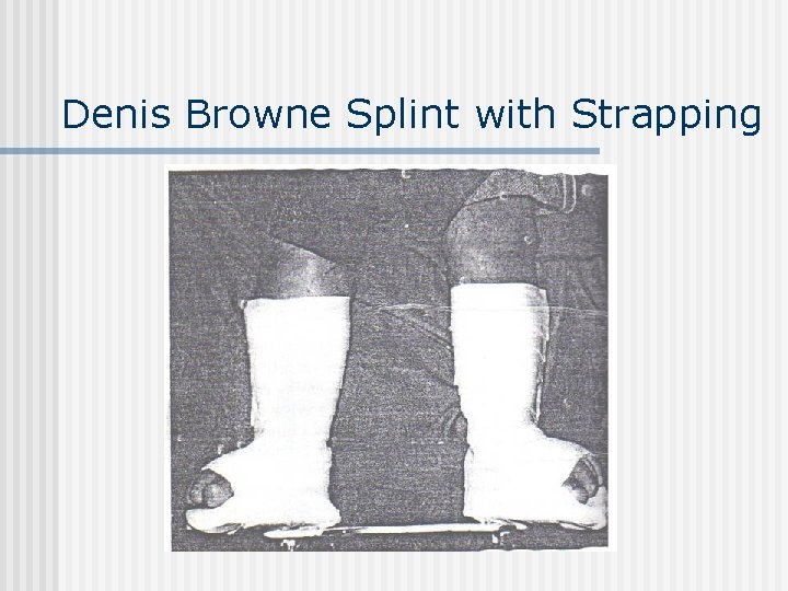 Denis Browne Splint with Strapping 
