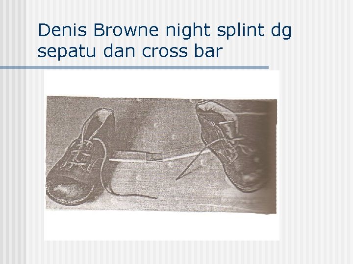Denis Browne night splint dg sepatu dan cross bar 