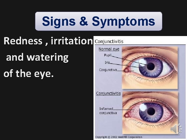 Signs & Symptoms Redness , irritation and watering of the eye. 21 