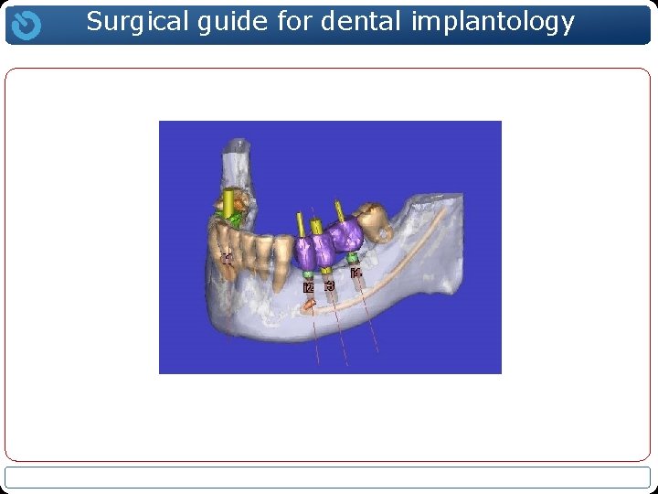 Surgical guide for dental implantology 