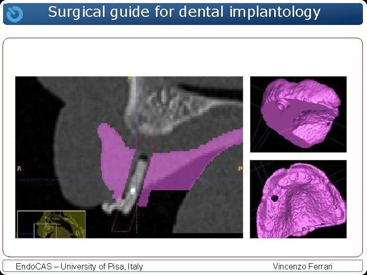 Surgical guide for dental implantology Endo. CAS – University of Pisa, Italy Vincenzo Ferrari