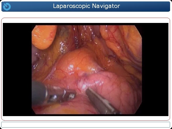 Laparoscopic Navigator 