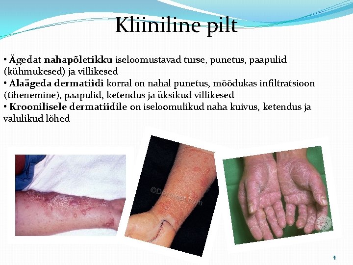 Kliiniline pilt • Ägedat nahapõletikku iseloomustavad turse, punetus, paapulid (kühmukesed) ja villikesed • Alaägeda