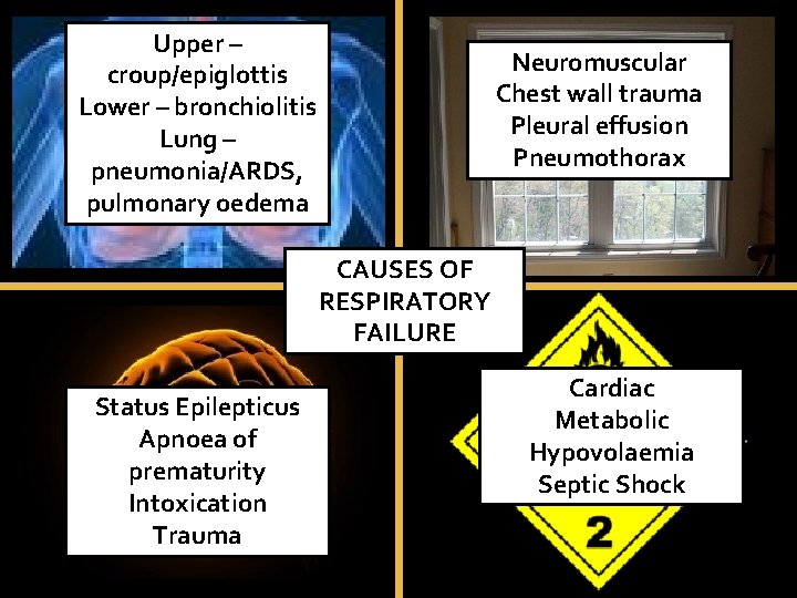Upper – croup/epiglottis Lower – bronchiolitis Lung – pneumonia/ARDS, pulmonary oedema Neuromuscular Chest wall Upper – croup/epiglottis Lower – bronchiolitis Lung – pneumonia/ARDS, pulmonary oedema Neuromuscular Chest wall