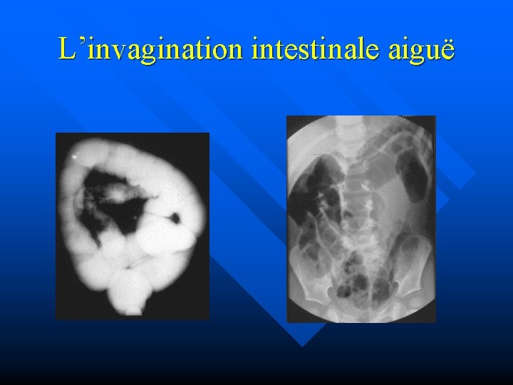 L’invagination intestinale aiguë 