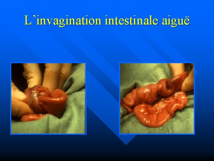 L’invagination intestinale aiguë 