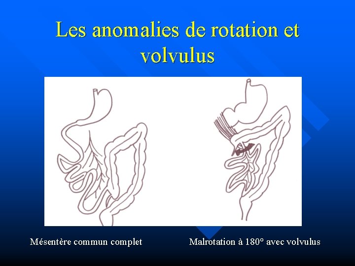 Les anomalies de rotation et volvulus Mésentère commun complet Malrotation à 180° avec volvulus