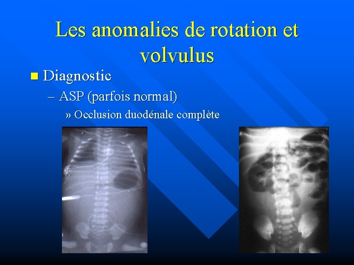 Les anomalies de rotation et volvulus n Diagnostic – ASP (parfois normal) » Occlusion