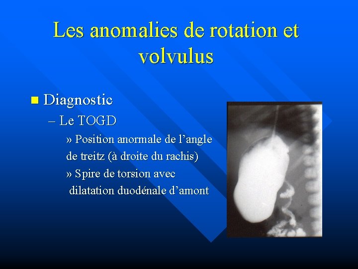 Les anomalies de rotation et volvulus n Diagnostic – Le TOGD » Position anormale