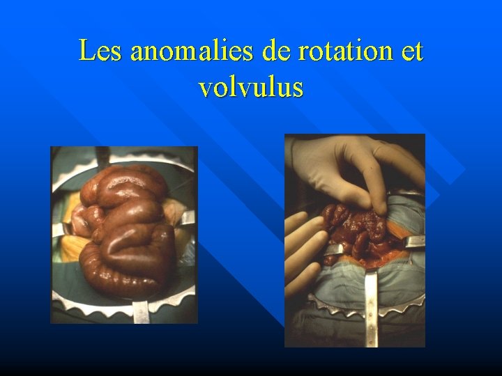 Les anomalies de rotation et volvulus 