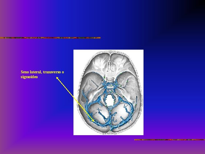 Seno lateral, transverso o sigmoideo 