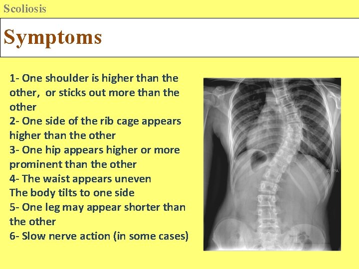 Scoliosis Symptoms 1 - One shoulder is higher than the other, or sticks out