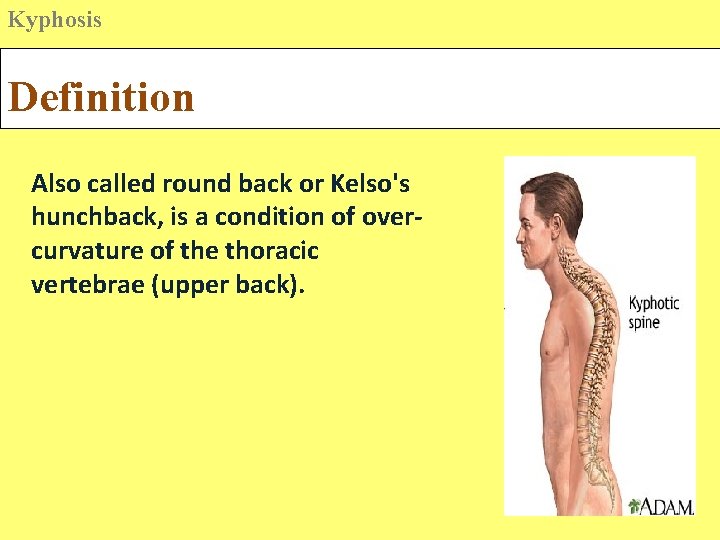 Kyphosis Definition Also called round back or Kelso's hunchback, is a condition of overcurvature