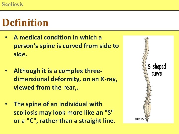 Scoliosis Definition • A medical condition in which a person's spine is curved from