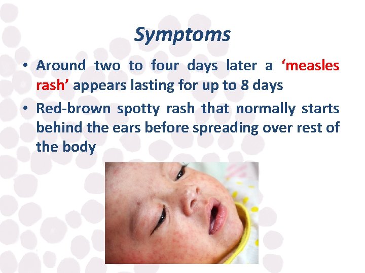 Symptoms • Around two to four days later a ‘measles rash’ appears lasting for