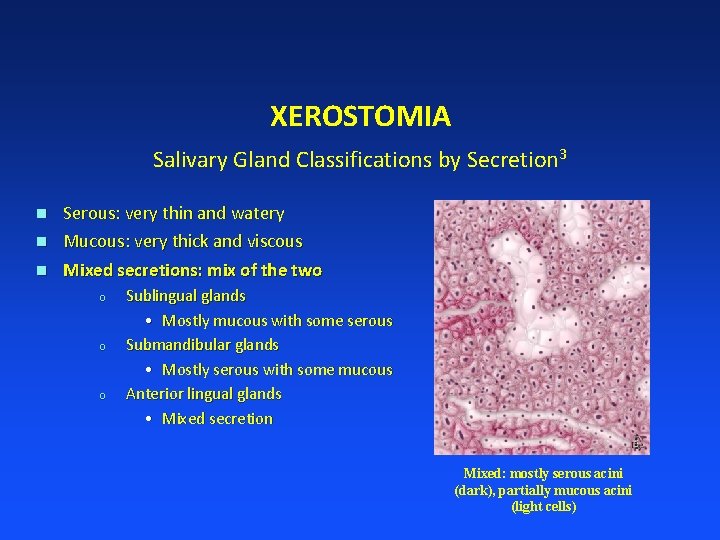 XEROSTOMIA Salivary Gland Classifications by Secretion 3 n Serous: very thin and watery Mucous: