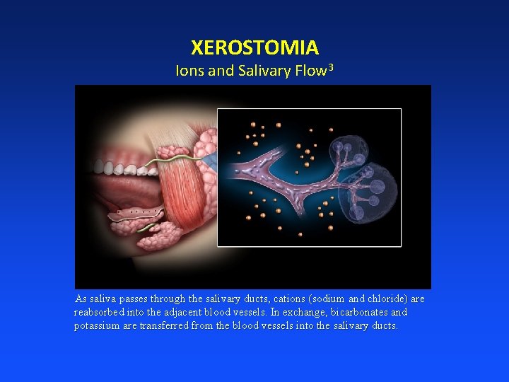 XEROSTOMIA Ions and Salivary Flow 3 As saliva passes through the salivary ducts, cations