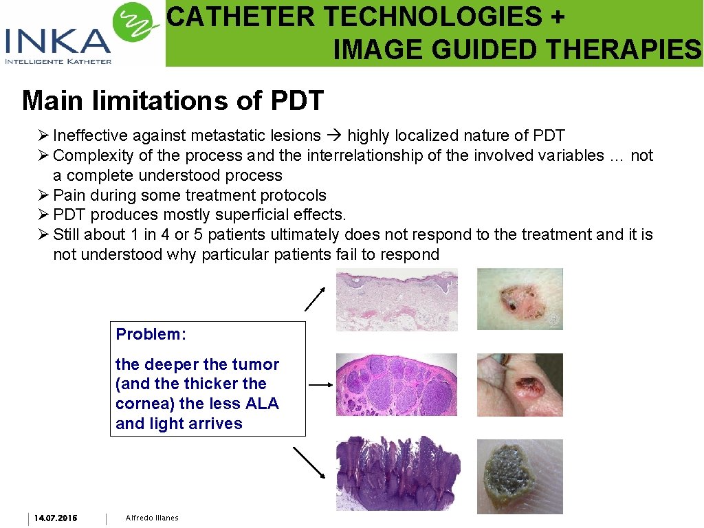CATHETER TECHNOLOGIES + IMAGE GUIDED THERAPIES Main limitations of PDT Ø Ineffective against metastatic
