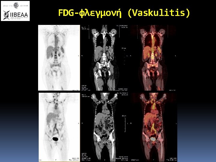 FDG-φλεγμονή (Vaskulitis) 