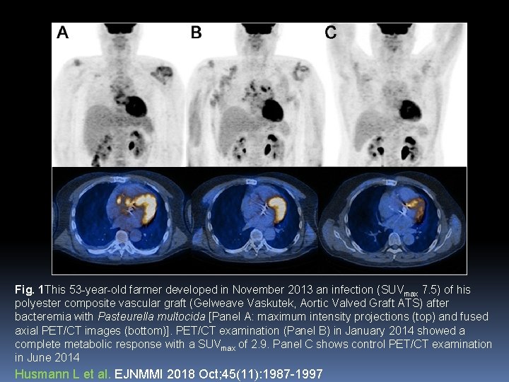 Fig. 1 This 53 -year-old farmer developed in November 2013 an infection (SUVmax 7.