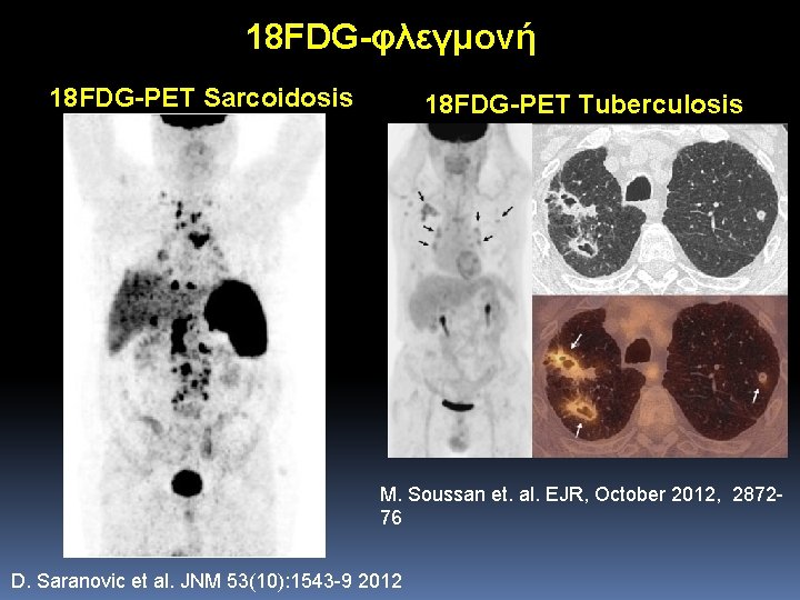 18 FDG-φλεγμονή 18 FDG-PET Sarcoidosis 18 FDG-PET Tuberculosis M. Soussan et. al. EJR, October