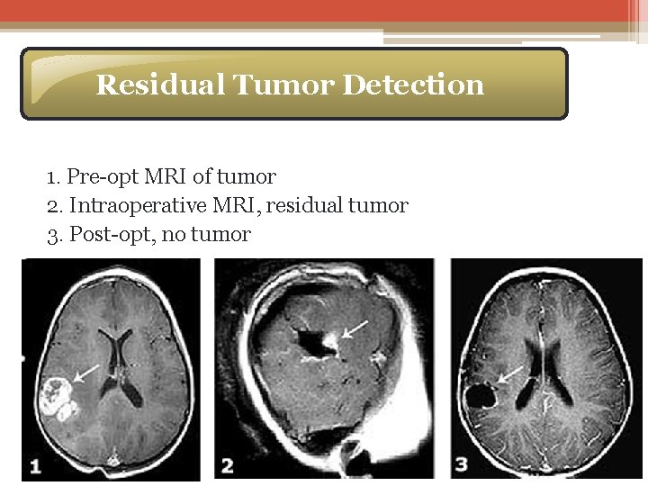 Residual Tumor Detection 1. Pre-opt MRI of tumor 2. Intraoperative MRI, residual tumor 3.