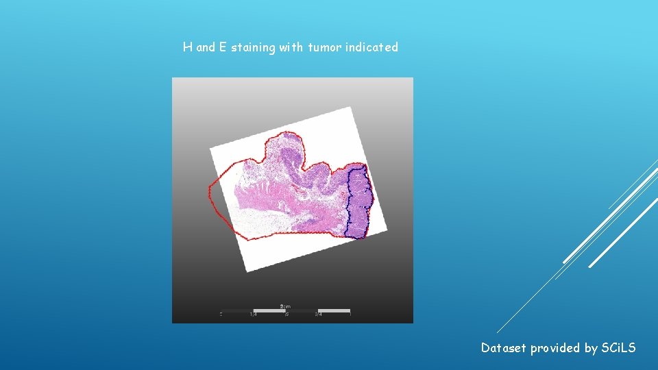 H and E staining with tumor indicated Dataset provided by SCi. LS 