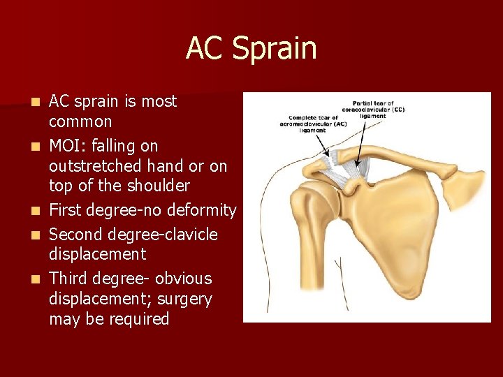 AC Sprain n n AC sprain is most common MOI: falling on outstretched hand