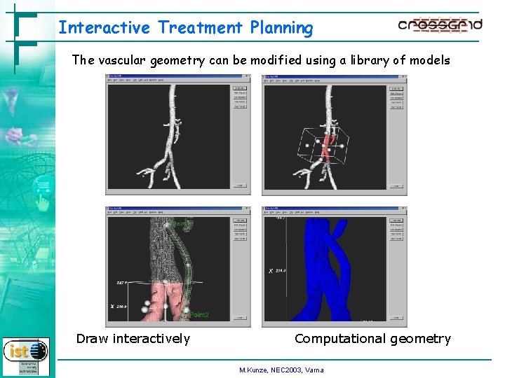 Interactive Treatment Planning The vascular geometry can be modified using a library of models