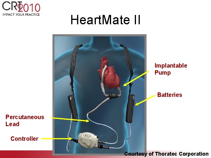 Heart. Mate II Implantable Pump Batteries Percutaneous Lead Controller Courtesy of Thoratec Corporation 