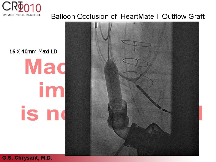 Balloon Occlusion of Heart. Mate II Outflow Graft 16 X 40 mm Maxi LD