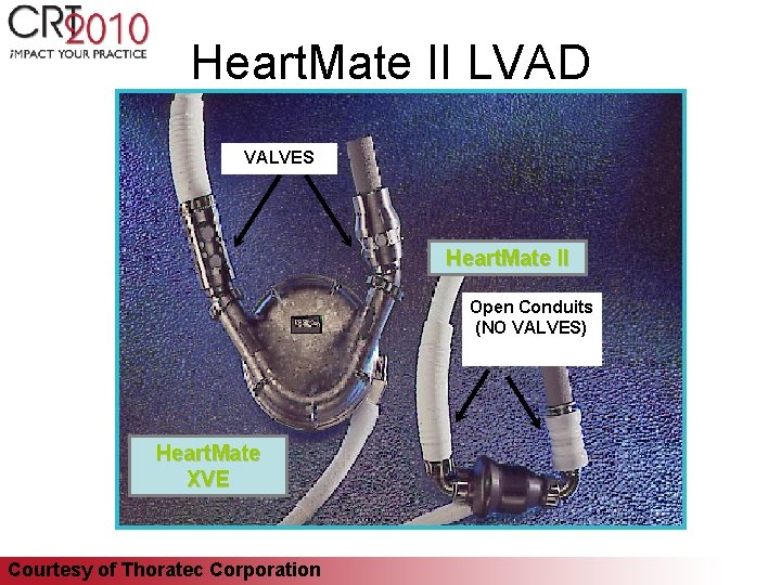 Heart. Mate II LVAD VALVES Heart. Mate II Open Conduits (NO VALVES) Heart. Mate