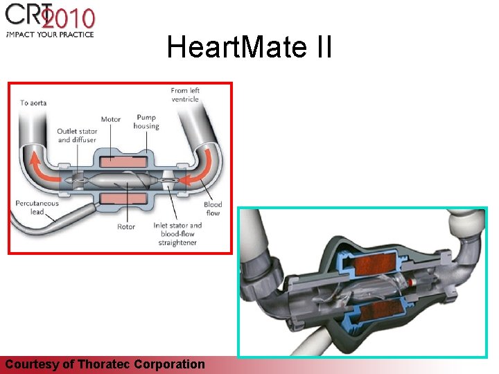 Heart. Mate II Courtesy of Thoratec Corporation 