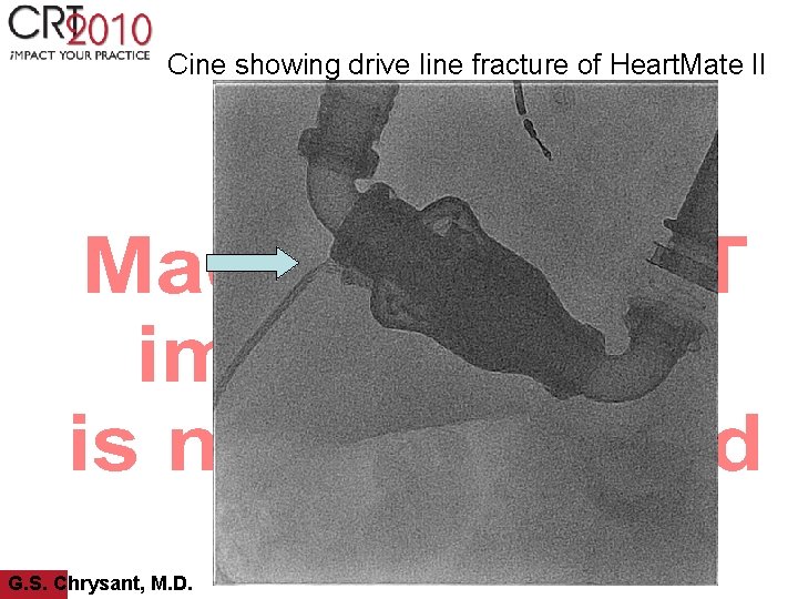 Cine showing drive line fracture of Heart. Mate II G. S. Chrysant, M. D.